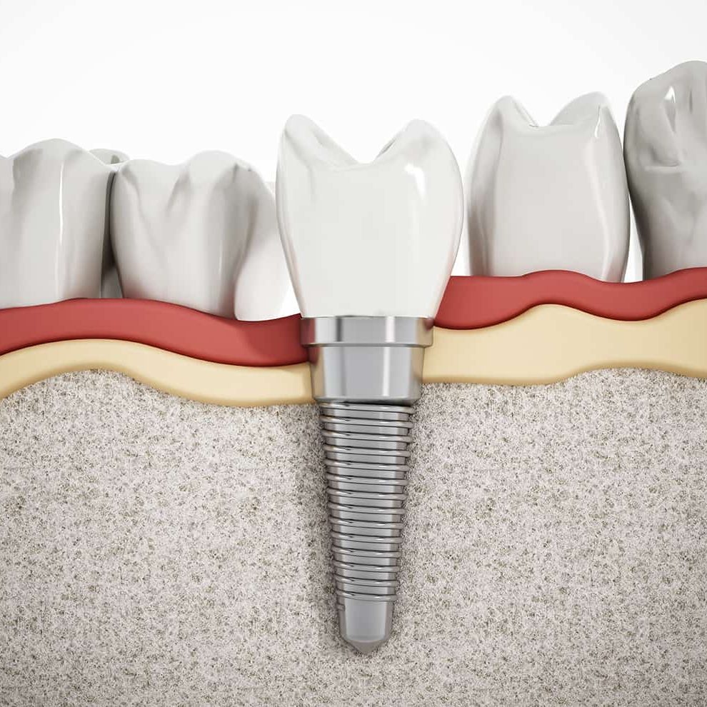 Illustration of teeth showing dental implant structure