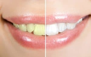 woman teeth before and after whitening